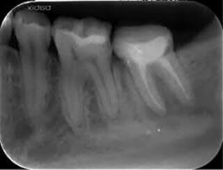 下顎の奥歯の歯の根