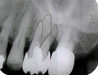 上顎の奥歯の歯の根