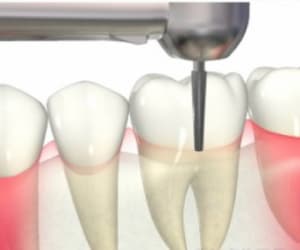 歯根分割法