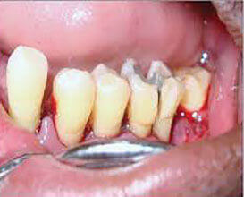 歯の分割