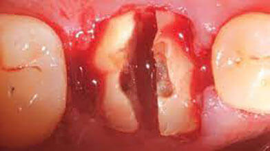 下顎の奥歯を分割