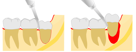 奥歯の歯の根の抜歯
