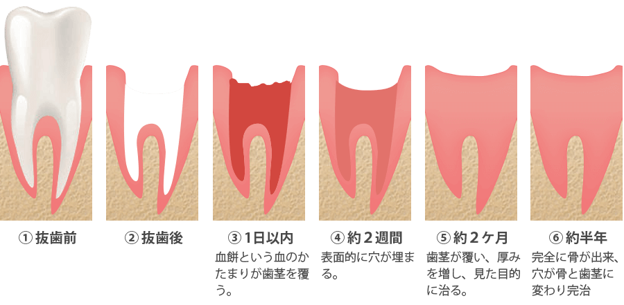 抜歯窩がふさがる過程