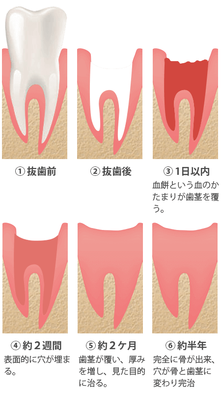 抜歯窩がふさがる過程