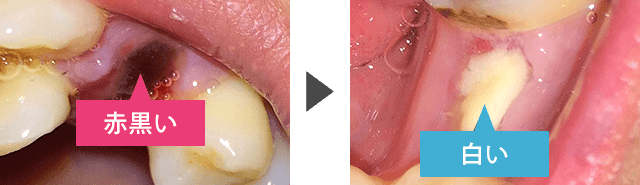 抜歯 後 白い ブヨブヨ 取れ た