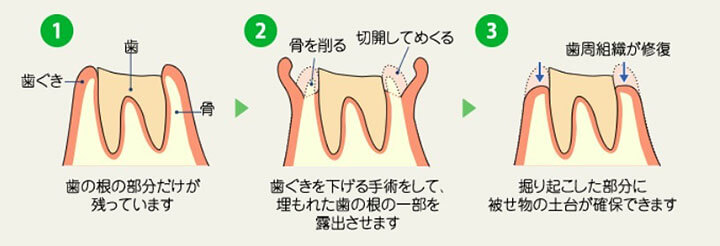 歯冠延長術の流れ