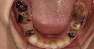 奥歯や前歯がボロボロ
