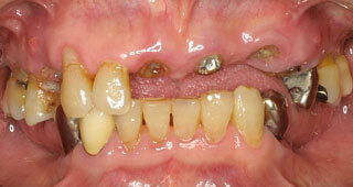奥歯や前歯がボロボロ