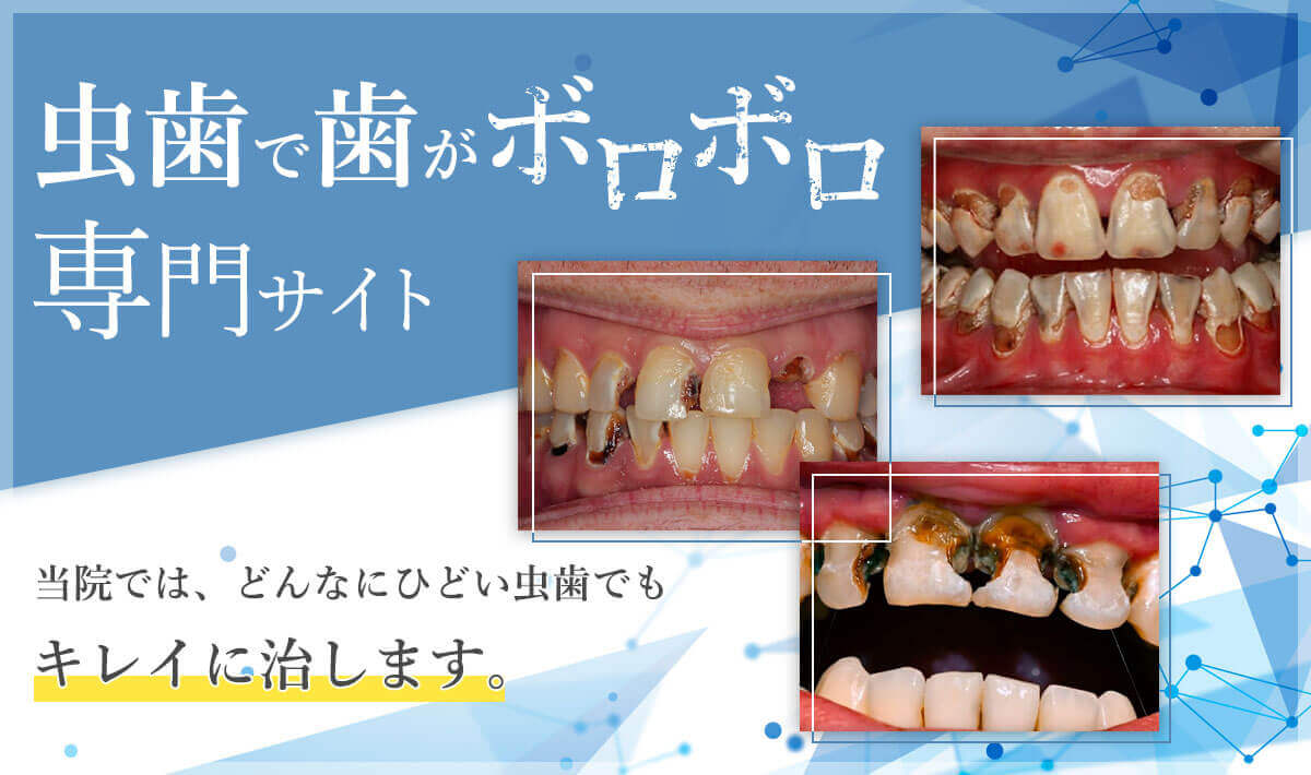 虫歯で歯がボロボロ専門サイト