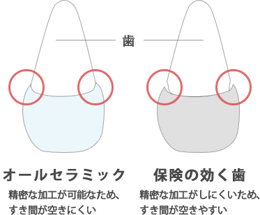 かぶせ物の比較