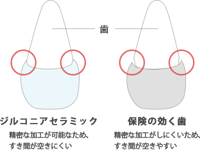 かぶせ物の比較