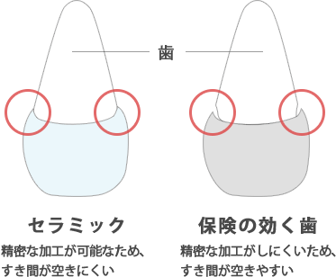 かぶせ物の比較