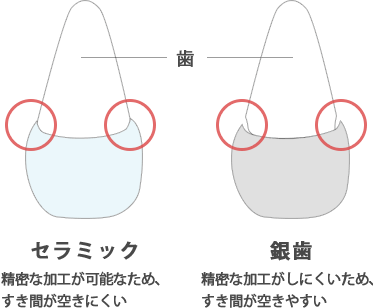 かぶせ物の比較