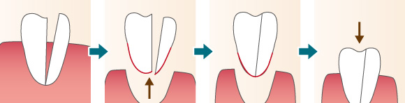 歯の再植法
