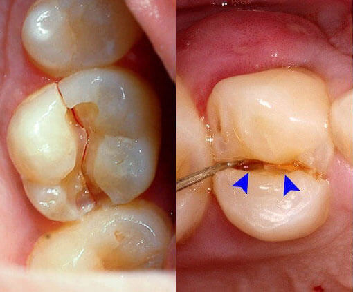 大臼歯が割れた場合、小臼歯が割れた場合