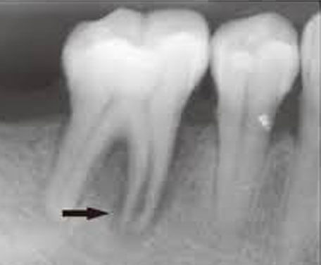 奥歯の歯根破折