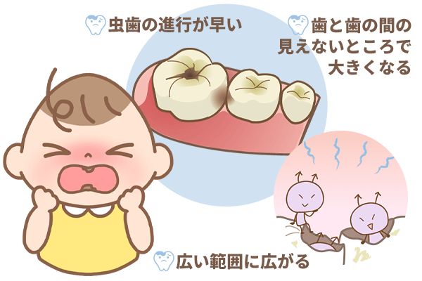乳歯の虫歯の特徴