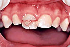 歯冠部で折れた乳歯