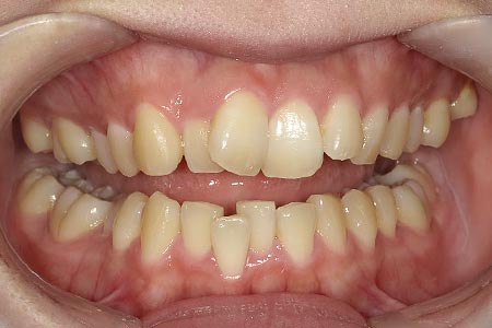 永久歯の前歯がガタガタ