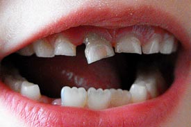 乳歯・子供の歯がグラグラ