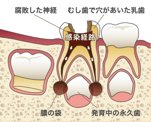 感染した乳歯と歯根の先の膿