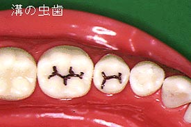 溝の虫歯