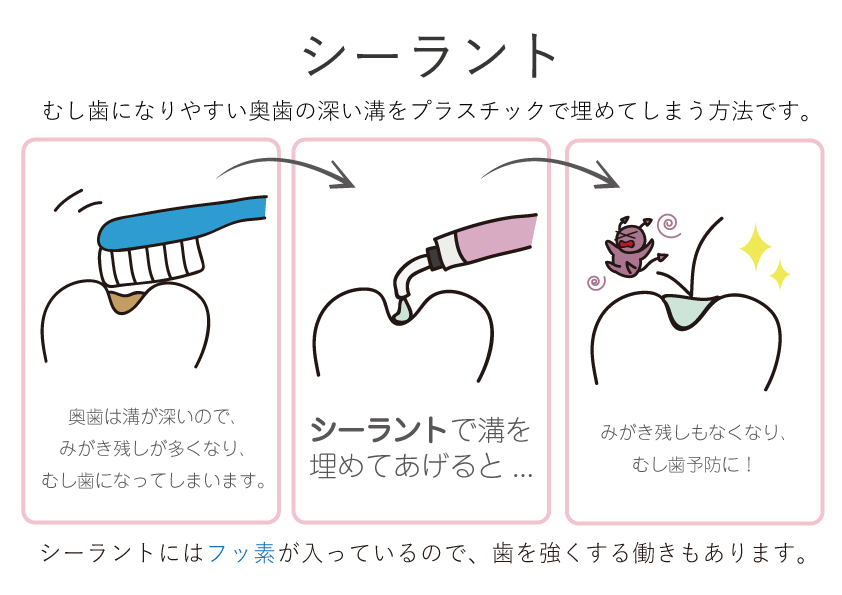 シーラント