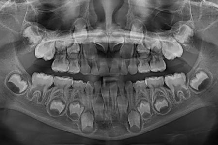 乳歯と永久歯