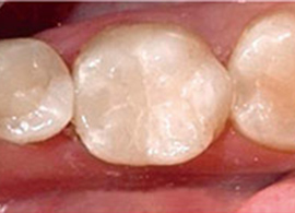 銀歯を白い歯にした症例写真1：治療後