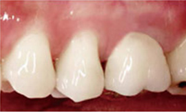 銀歯を白い歯にした症例写真1：治療後