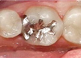 銀歯を白い歯にした症例写真1：治療前