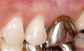 銀歯を白い歯にした症例写真1：治療前