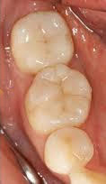 銀歯を白い歯にした症例写真2：治療後