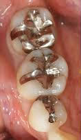 銀歯を白い歯にした症例写真2：治療前