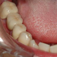 銀歯を白い歯にした症例写真3：治療後
