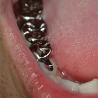 銀歯を白い歯にした症例写真3：治療前