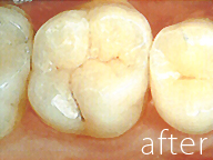 銀歯を白い歯にした症例写真4：治療後