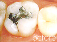 銀歯を白い歯にした症例写真4：治療前