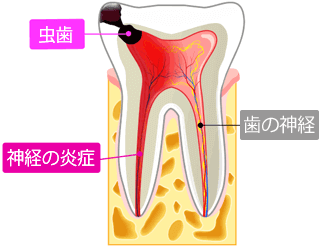 歯 が 痛く て 頭 が 痛い