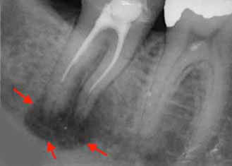 根尖病巣の歯のレントゲン