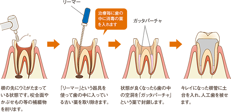 歯の根の治療方法