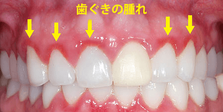 前 歯痛 生理 生理前になると歯痛が始まる、これってもしかしたら？