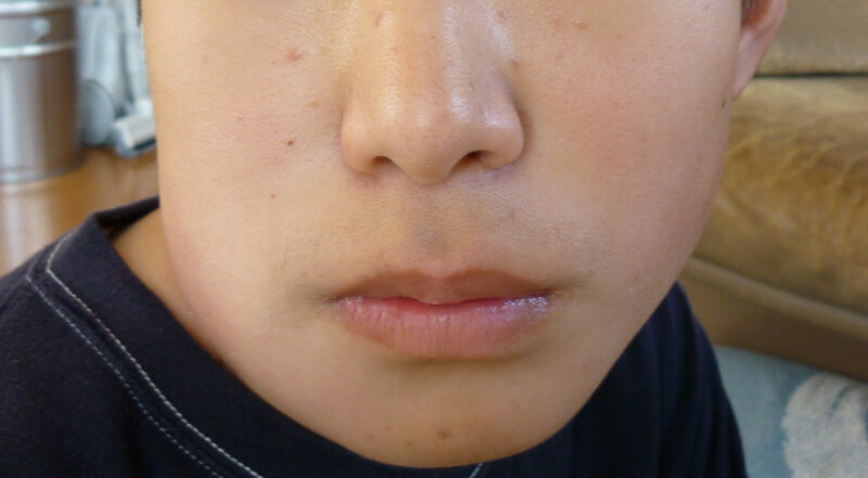 過食症による頬の腫れを治療するにはどのような選択肢がありますか?