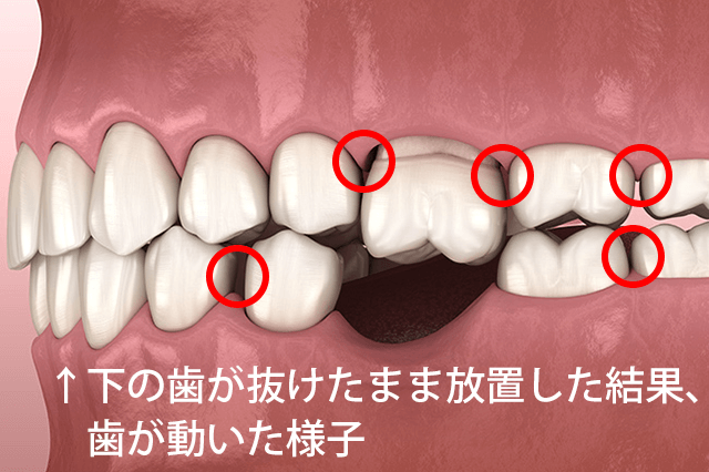 歯 の 間 に 挟まる 痛い