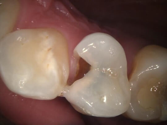 歯と歯の間の虫歯が出来た
