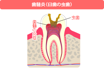 歯の神経の炎症