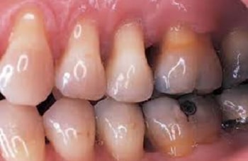 歯の象牙質が露出