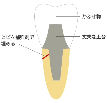 歯のヒビの治療