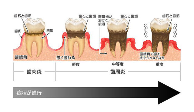 歯肉炎から歯周病へ病状の進行