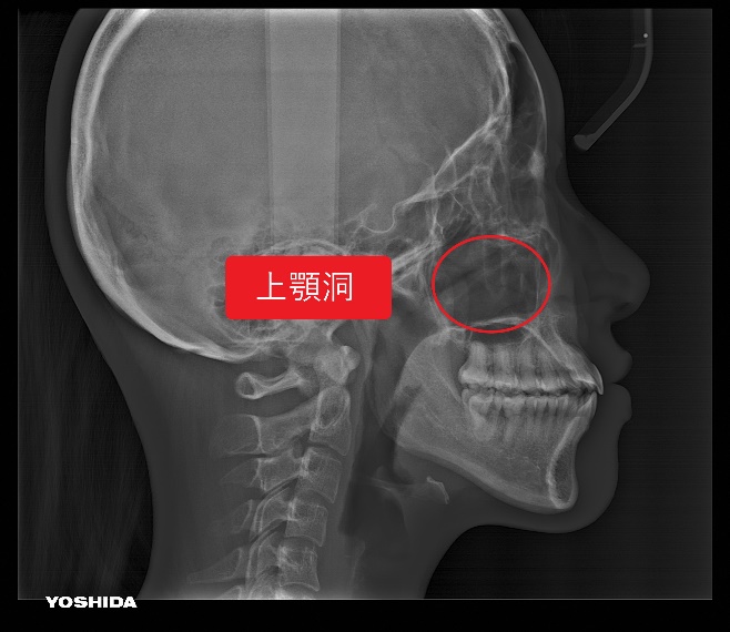 副鼻腔炎（蓄膿症、上顎洞炎）で歯が痛い原因と治療法・対処方法｜医療法人真摯会 クローバー歯科・まつもと歯科